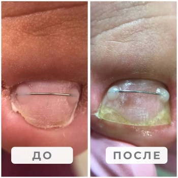 Вросший ноготь