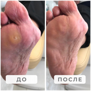 Обработка стопы