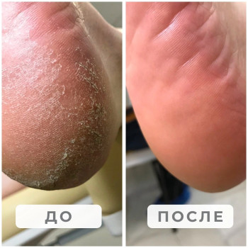 Обработка кератоза