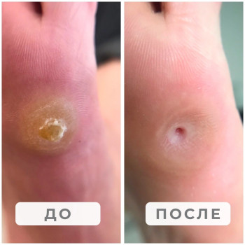 Обработка глубокой мозоли