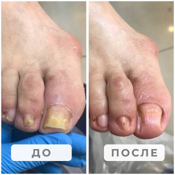 Обработка ногтей
