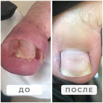 Вросший ноготь