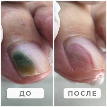 Синегнойная палочка (плесень)