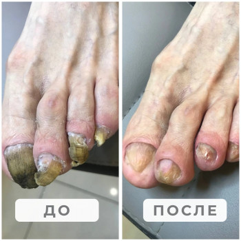 Онихогрифоз и онихомикоз