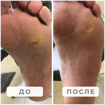 Обработка стопы