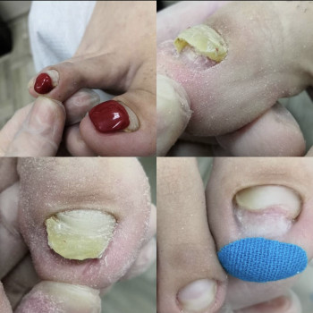 Восстановление травмированного ногтя