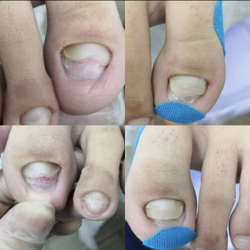 Восстановление ногтя 