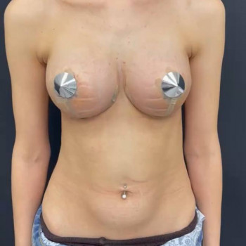 Якорная подтяжка груди на имплантах