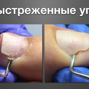 Коррекция вросшего ногтя
                    Podologe Анастасия Гуляева Tyumen