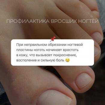 Коррекция вросшего ногтя
                    Podologe Анастасия Гуляева Tyumen