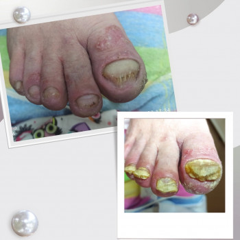 Псориаз ногтей и стоп 