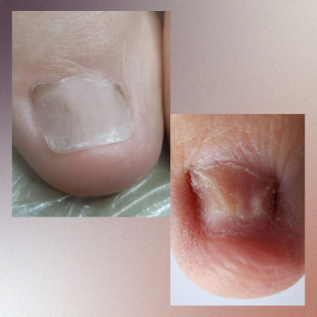 Протезирование ногтя