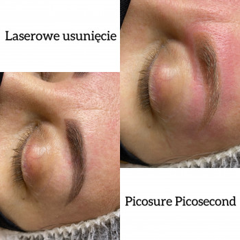 Лазерное удаление перманентного макияжа бровей 
                    Студия перманентного макияжа и лазерной эпиляции  CAPRISE Warsaw