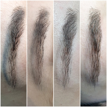 Удаление некачественного татуажа 4 процедуры