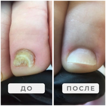 Онихомикоз