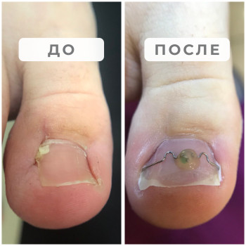 Вросший ноготь, восстановление после хирурга