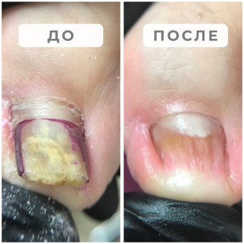 Онихомикоз, спрятанный под покрытием