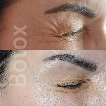 Ботокс глаз