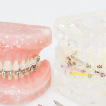 Пластина для выравнивания зубов