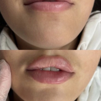 Процедура : скорректировали овал лица и аугментация губ 
Пре