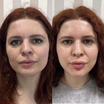 Коррекция губ и подбородка для гармонизации лица