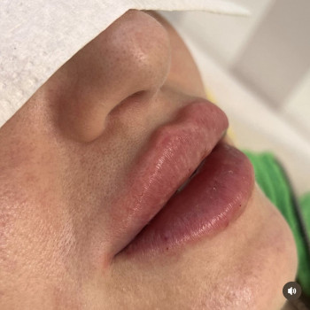 Коррекция губ гиалуроновой кислотой