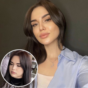 Техника Full-Face гиалуроновой кислотой