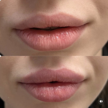 Коррекция губ гиалуроновой кислотой