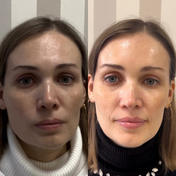 Работа с асиметричностью лица и губ ботулотоксином не филлер