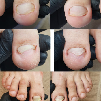 Removal of calluses