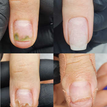 Removal of calluses