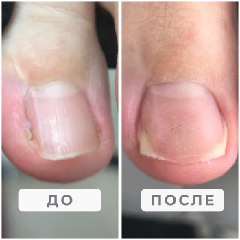 Вросший ноготь, восстановление после хирурга