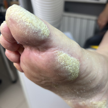 Кожные заболевание стоп
Коррекция ухода за проблемной стопо