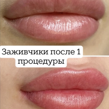 Губы перед коррекции / после процедуры ПМ