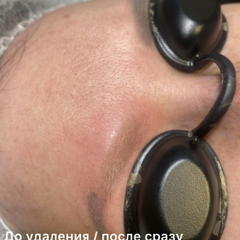 Удаление старого татуажа бровей