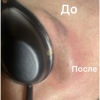 Удаление серых бровей