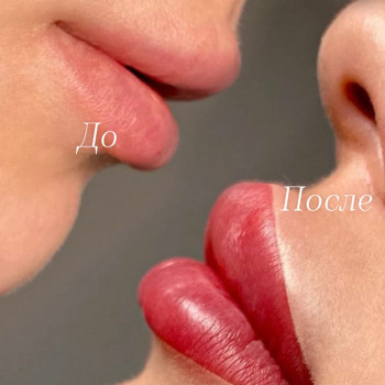 Губы до / после процедуры ПМ