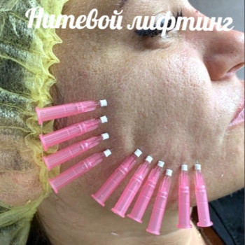 Нитевой лифтинг.