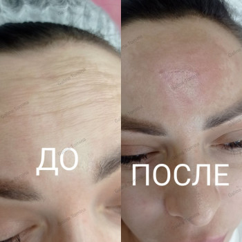 Биорепарация, веерный лифтинг
                    Врач-косметолог Галина Томина Варшава
