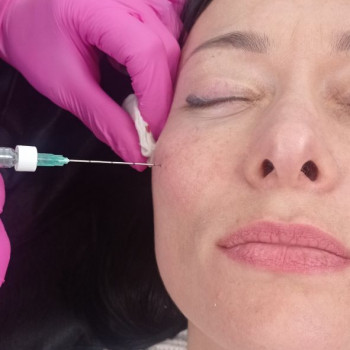 Биорепарация, веерный лифтинг
                    Врач-косметолог Галина Томина Варшава