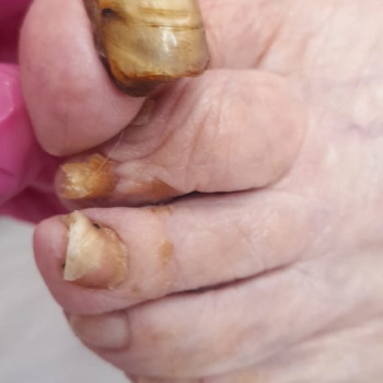 Грибковое поражение ногтевой пластины