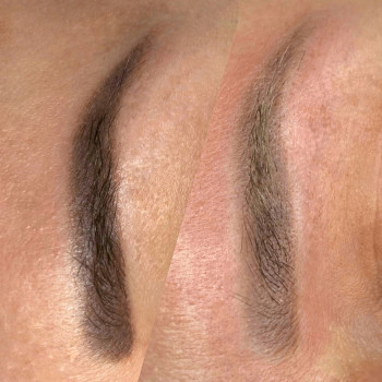 Удаление перманентного макияжа лазером