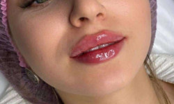 Контурная пластика губ Cosmetologist Natalia Sambur Omsk