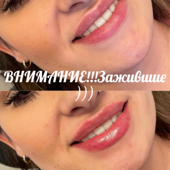 Контурная пластика губ
                    Kosmetyczka Natalia Sambur Omsk