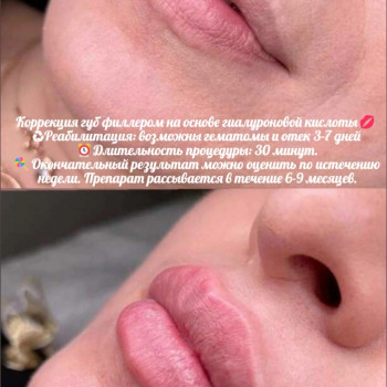 Контурная пластика губ
                    Kosmetyczka Natalia Sambur Omsk