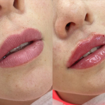 Контурная пластика губ
                    Kosmetyczka Natalia Sambur Omsk