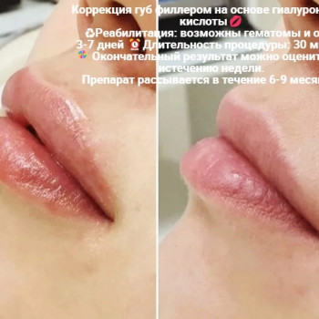 Контурная пластика губ
                    Kosmetyczka Natalia Sambur Omsk