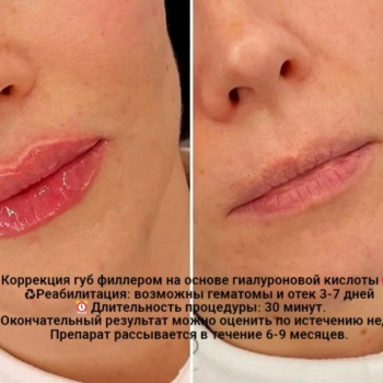 Контурная пластика губ
                    Kosmetyczka Natalia Sambur Omsk