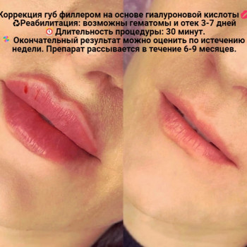 Контурная пластика губ
                    Kosmetyczka Natalia Sambur Omsk