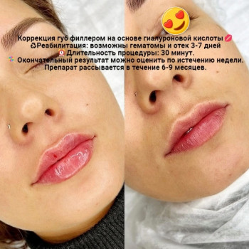 Контурная пластика губ
                    Kosmetyczka Natalia Sambur Omsk